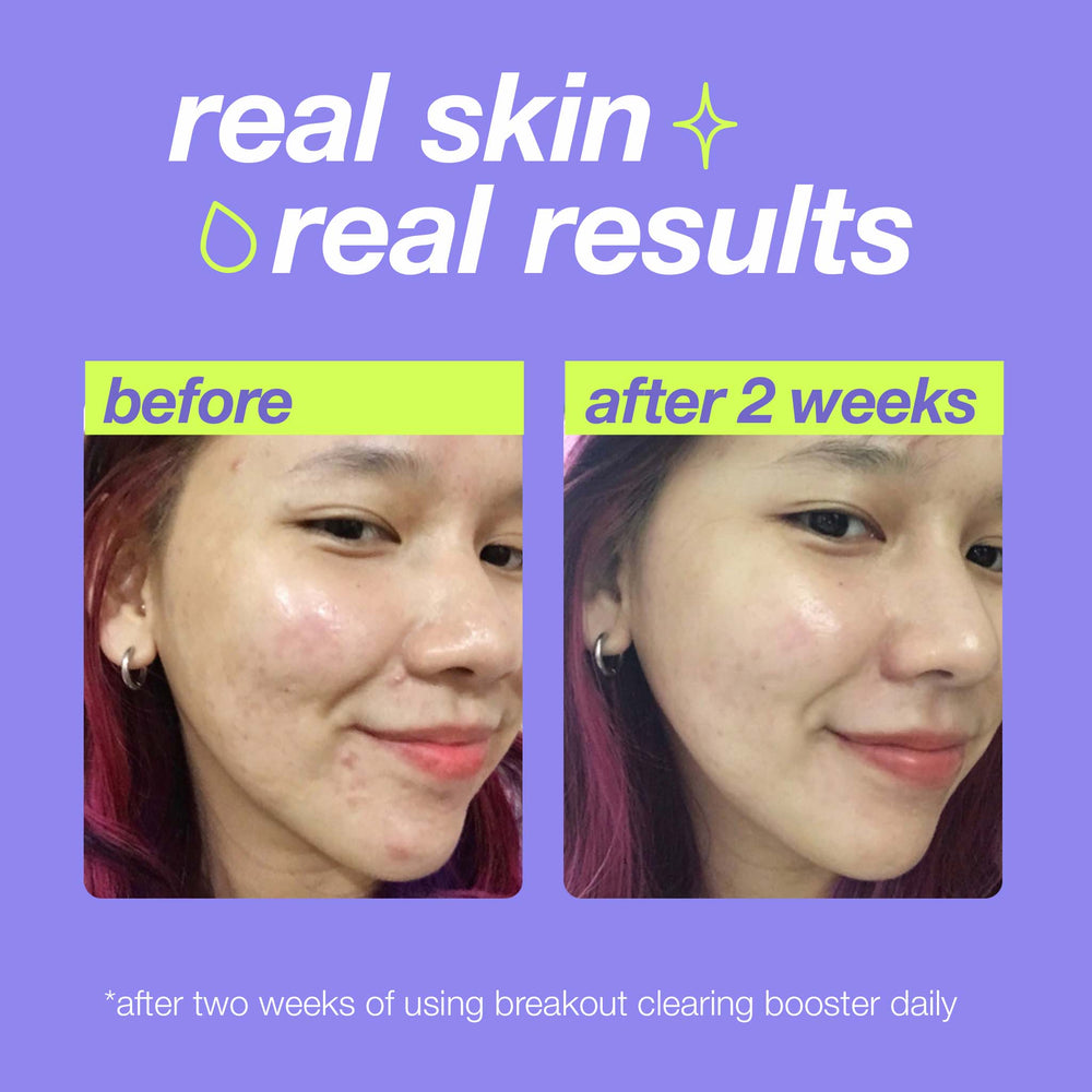 Before and after comparison of skin with 'real skin, real results' text on a purple background.