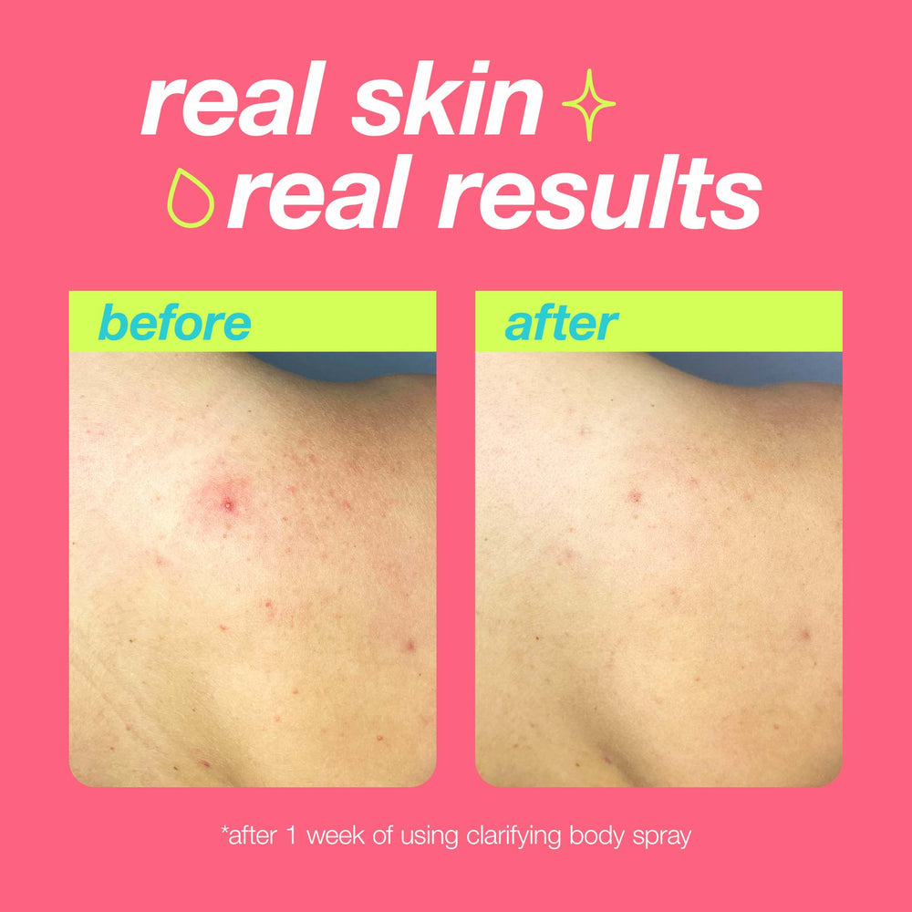 Before and after comparison of skin using a clarifying body spray on a pink background.