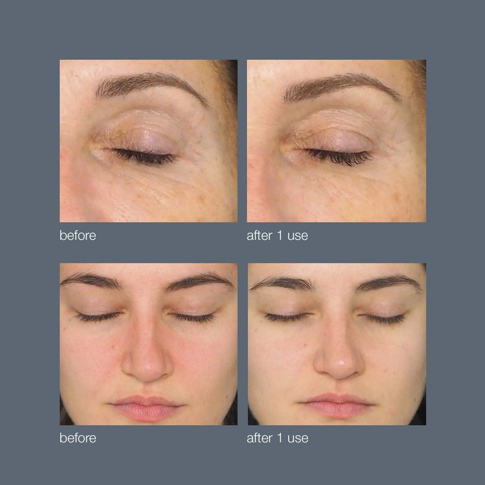 Before and after comparison of eye area treatment on a person's face.