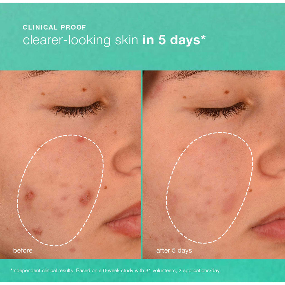 Before and after comparison of skin treatment showing clearer-looking skin in 5 days.