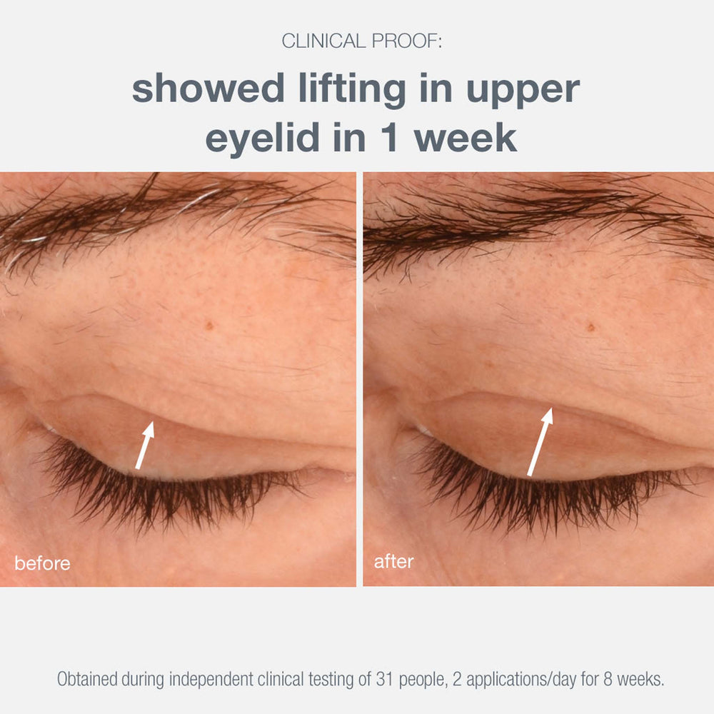 Before and after comparison of upper eyelid skin with text indicating lifting effect.